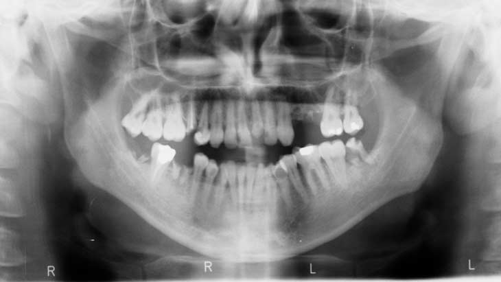 broken-tooth-radiography-1558768-1279x624